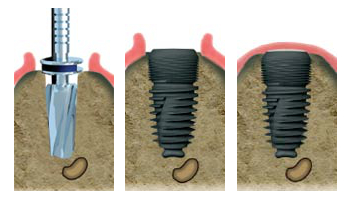 Spécialiste implant dentaire Paris 3