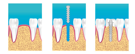 Spécialiste implant dentaire Paris 3